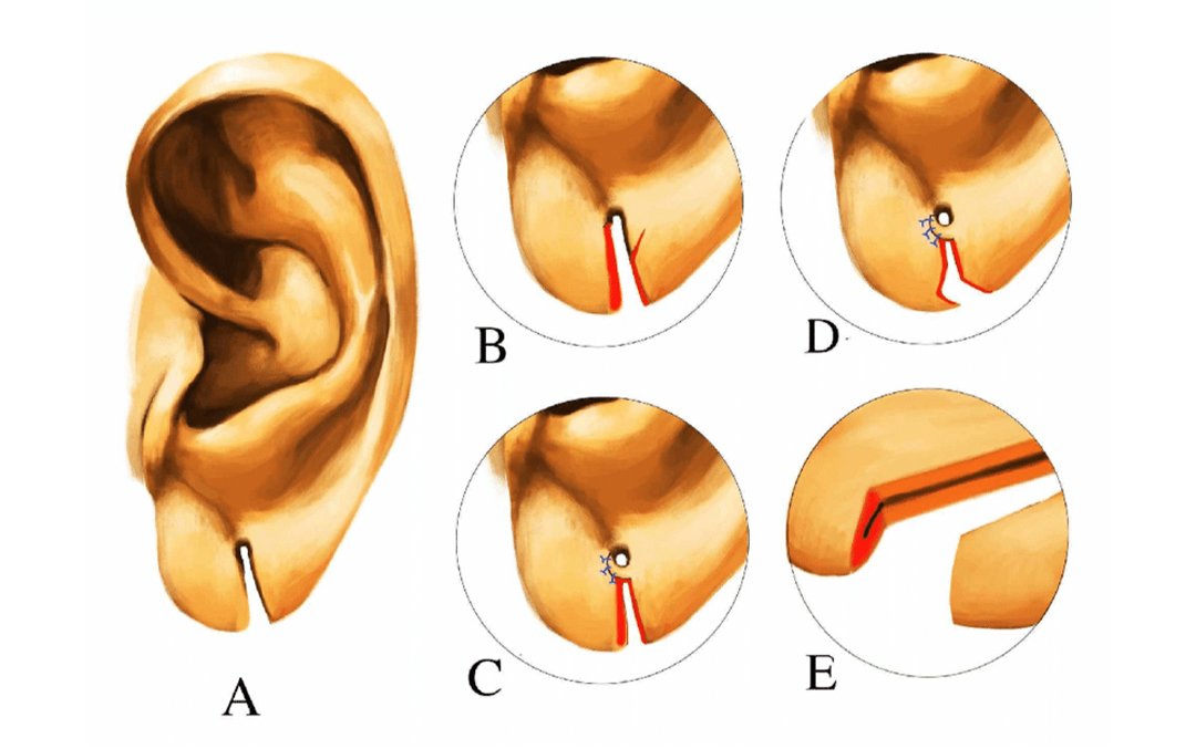 Ear Disintegration Top ENT Specialist in Gurgaon | Dr. Manish Prakash